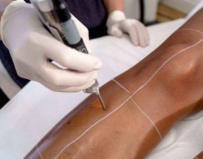 Pourquoi Choisir l&rsquo;Épilation au Laser ? Réponses à Vos Interrogations