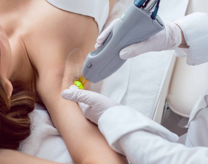 Épilation Laser des Aisselles à Fès : Prix de l&rsquo;Épilation Définitive des Aisselles au Maroc
