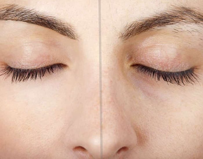 épilation définitive sourcil fes : Centre epilation definitive à Fès Maroc